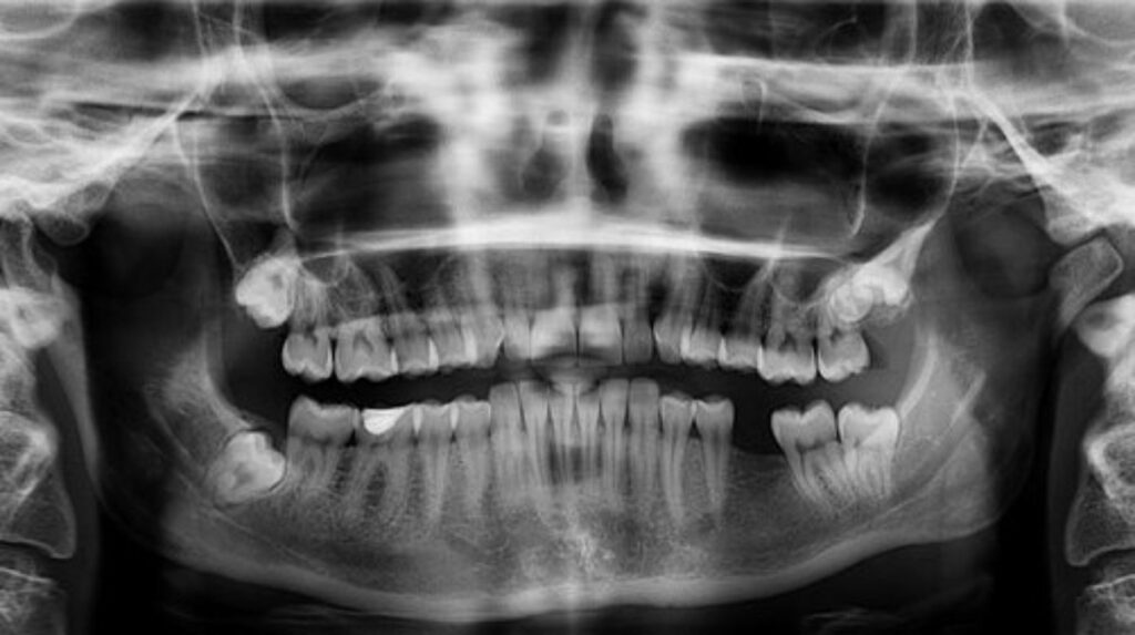 Röntgenaufnahme eines Kiefers