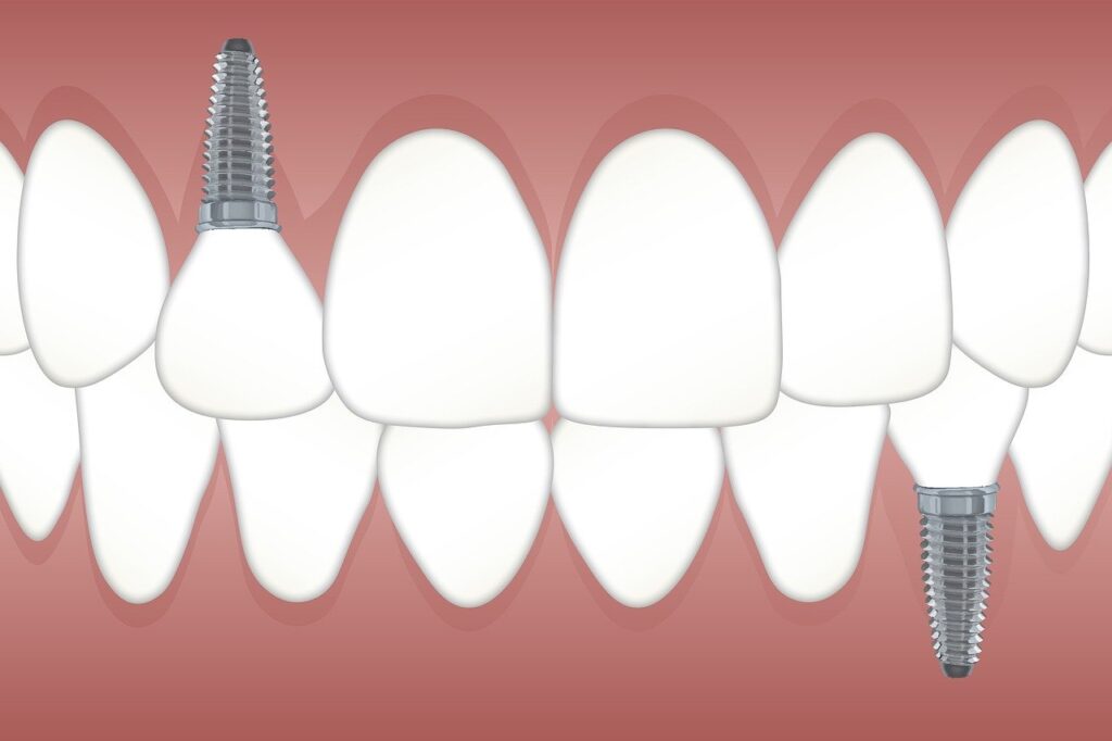 Grafische Illustration eines Zahngebisses mit jeweils ein Implantat im Ober- und eins im Unterkiefer.